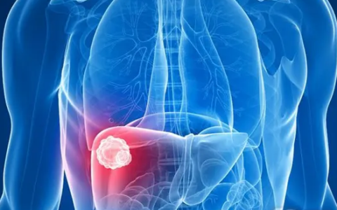 被忽视的肝癌局部治疗：质子治疗，单用或联合PD-1高效低毒