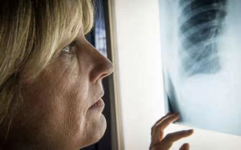 2023年世界肺癌大会公布两项肺癌治疗新成果